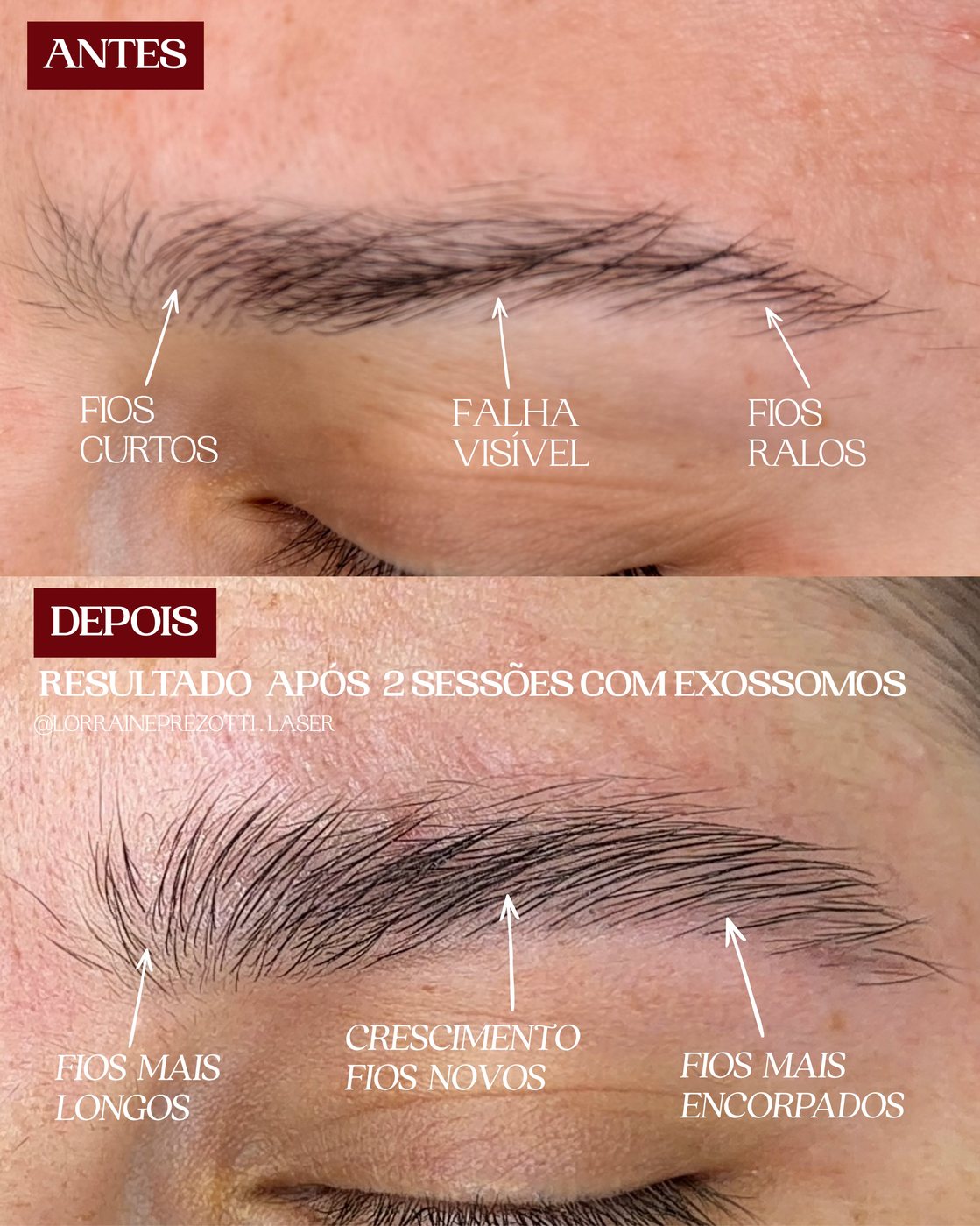 ExoBrows — antes e depois
