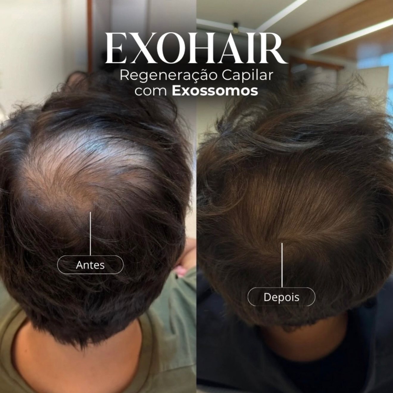 ExoHair — antes e depois