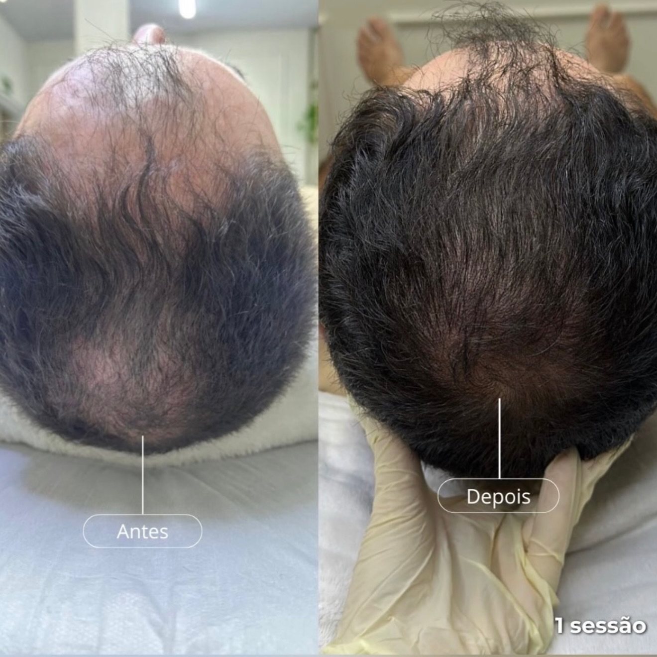 ExoHair — antes e depois