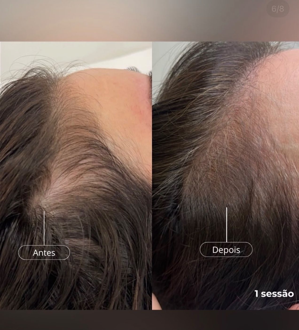 ExoHair — antes e depois