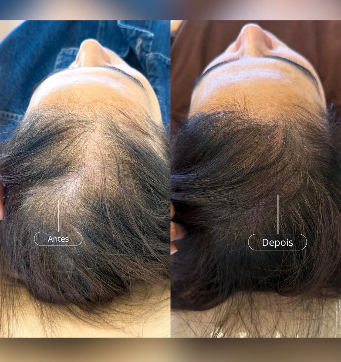 ExoHair — antes e depois