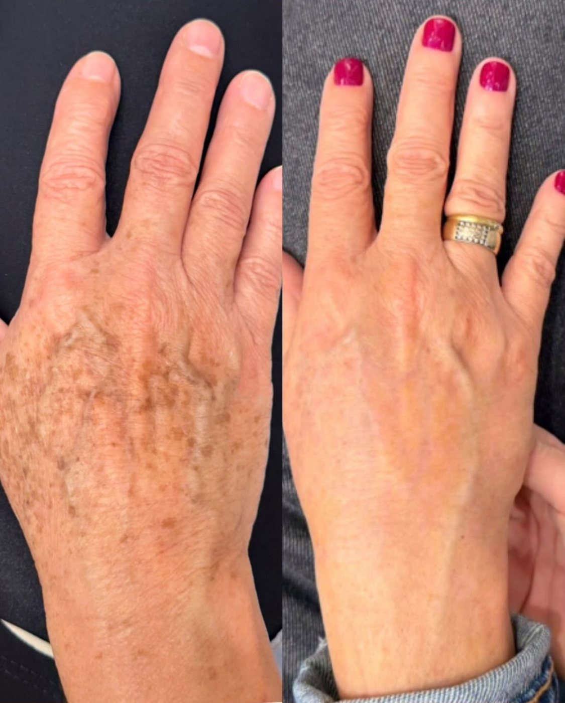 Clareamento de manchas — antes e depois
