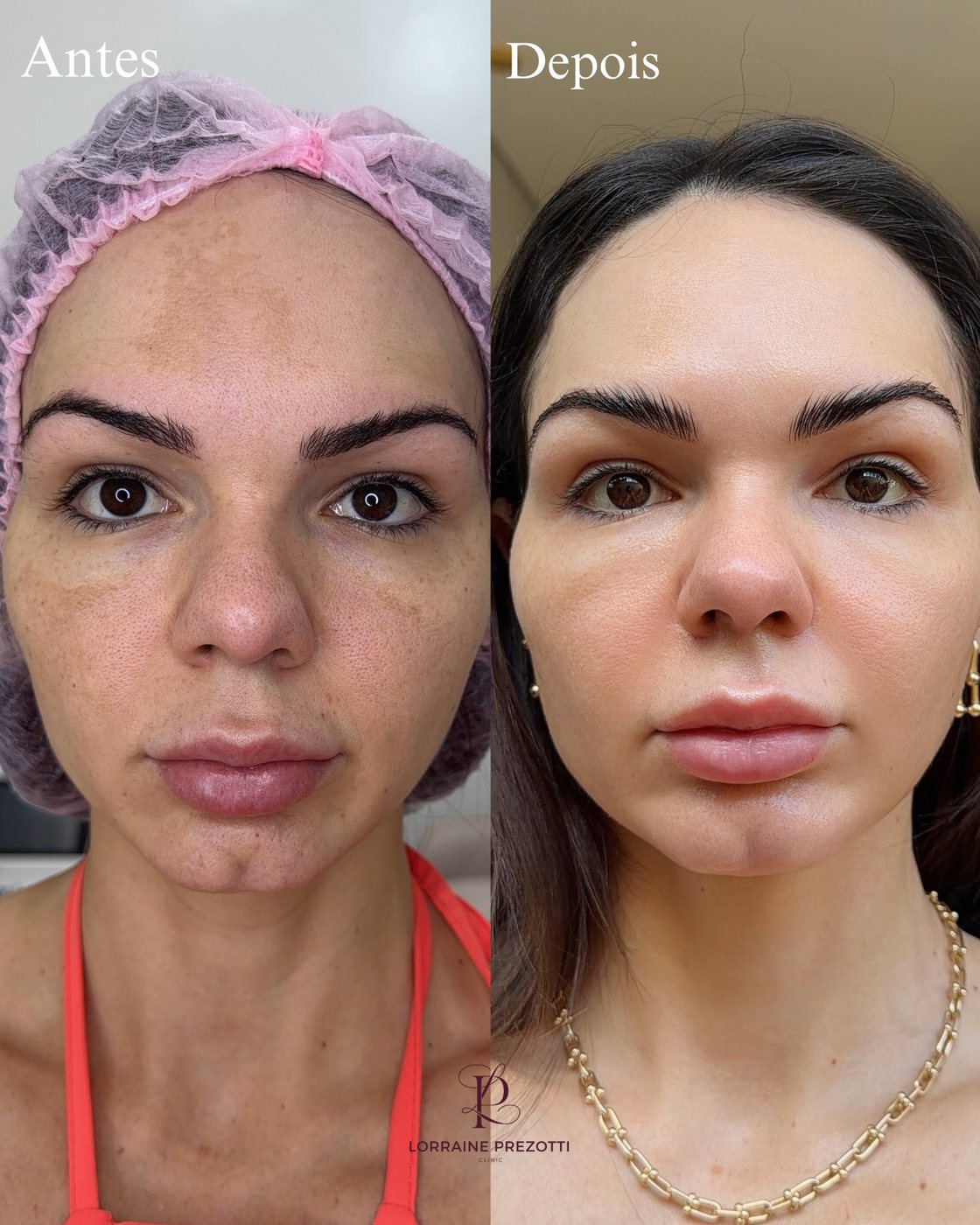 Protocolo facial — antes e depois