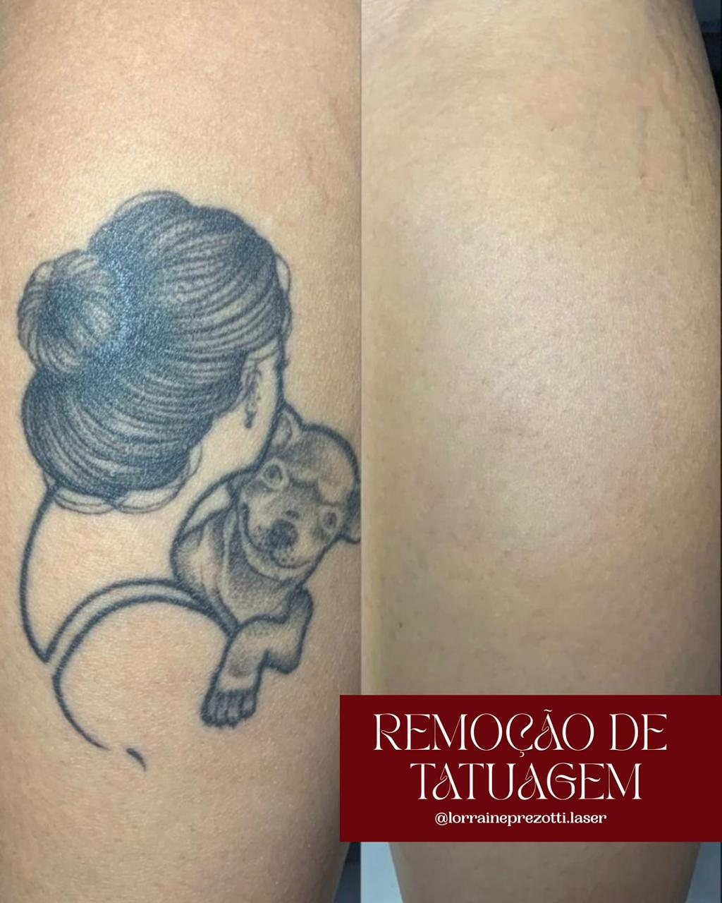Remoção de tatuagem — antes e depois